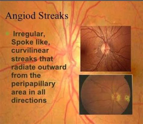 Angioid Streaks Ophthalmology Notes And Synopses