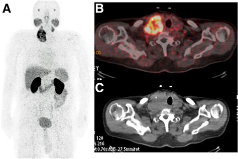 Incidental Detection Of Follicular Thyroid Carcinoma In 68ga Psma Pet
