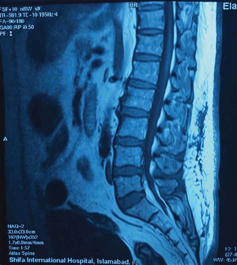 Mri Lumbosacral Spine Of The Patient Showing Mild To Moderate Lumbar