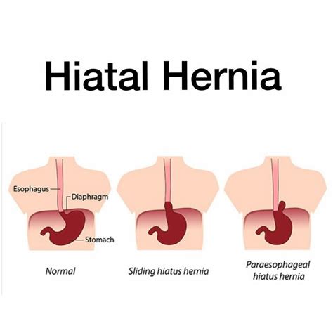 Gallery Of Types Of Hiatal Hernia Hiatus Hernia Hernia Symptoms Pathophysiology Of Umbilical