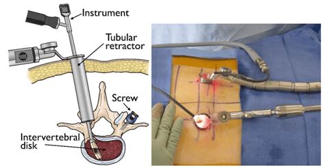 Minimal Invasive Spine Surgery Dr Shardul Soman