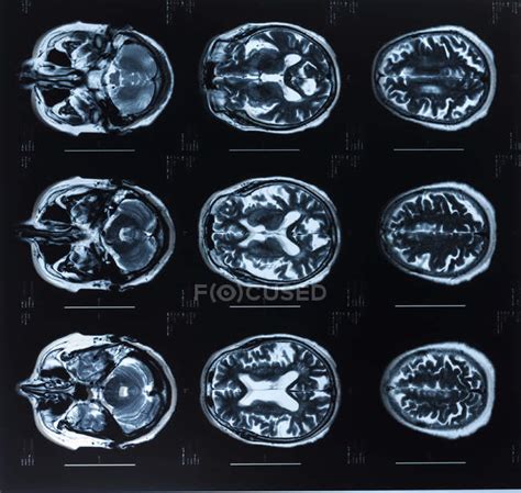 Magnetic Resonance Imaging Scans Of Human Brain — Science Radiation