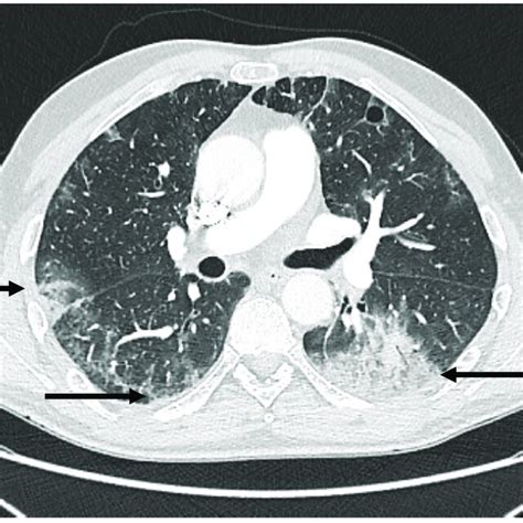 Chest Ct Axial Scan Lung Window Showing Multiple Bilateral And Mostly