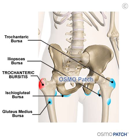 Always stretch and do warmup and. Hip Bursitis Information - What is Hip Bursitis? | OSMO ...