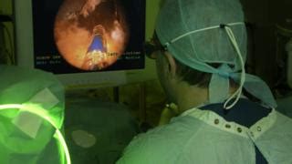Prostate Laser Therapy Recommended To Nhs Bbc News