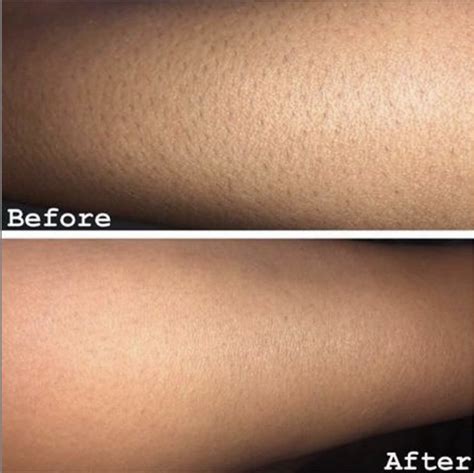 Premier Laser Clinic Best Laser Hair Removal In London And Surrey