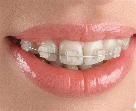 Clear Ceramic Braces What You Need To Know Petercatrecordingco