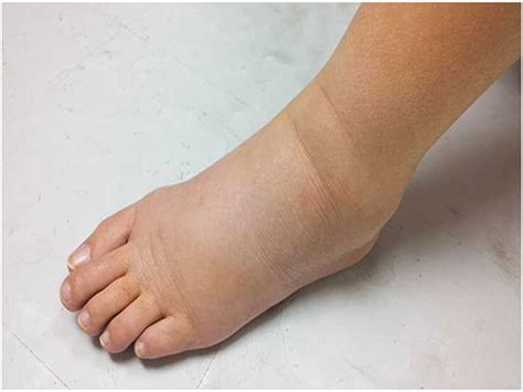 Leg Swelling And Heart Failure Edema Symptoms And Causes