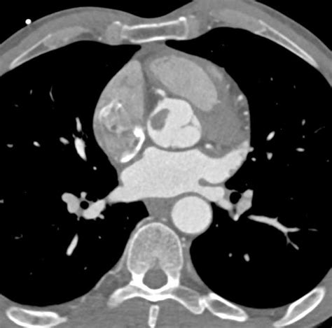 Papillary Fibroelastoma Of The Aortic Valve Cardiac Case Studies