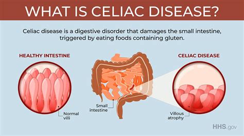 Villi Small Intestine Celiac Disease