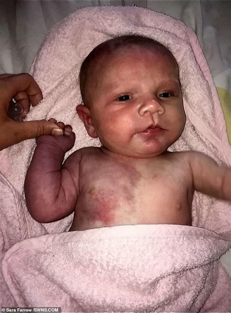 Mother Of Girl Born With Purple Birthmarks Hid Her From Strangers For Six Weeks After She Was