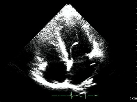 Elongated Anterior Mitral Leaflet And Hypoplasia Of Posterior Leaflet
