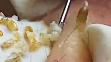 Cystic Acne Extraction This Week Blackheads Removal Blackhead Extraction13 Youtube