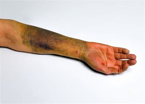 Bruised Arm Photograph By Victor De Schwanbergscience Photo Library