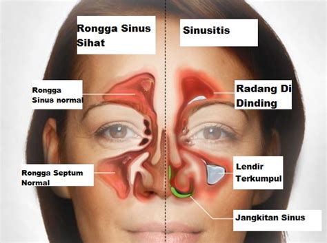 Menjalani rawatan menggunakan asap adalah kaedah tradisional popular dalam kalangan pesakit resdung. Penipuan Ulat Resdung ~ akufisio.blogspot
