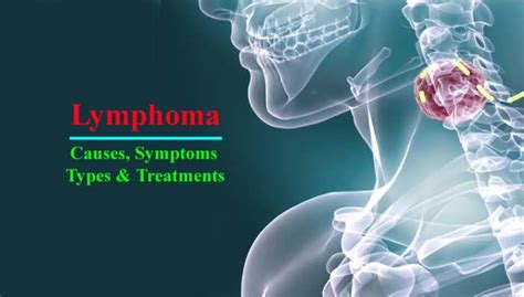 Lymphoma Definition Types Causes Symptoms And Treatments Lymphoma Symptoms Lymphoma