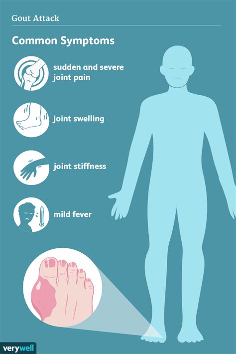 How Gout Is Treated