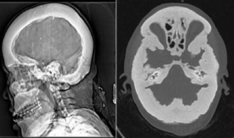 Sagittal Topogram And Axial Ct Scan Demonstrate A Diffuse Thickening Of