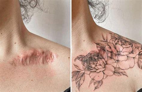 Iconic Transformations Of Scars Into Beautiful Tattoos