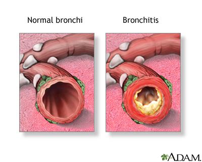 Clinical practices for intermediate sweat tests following abnormal cystic fibrosis newborn screens. Acute bronchitis: MedlinePlus Medical Encyclopedia