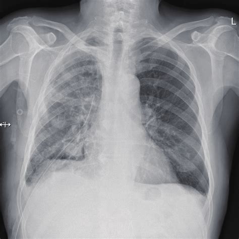 Chest X Ray Posterior Anterior View After The Surgical Removal Of The