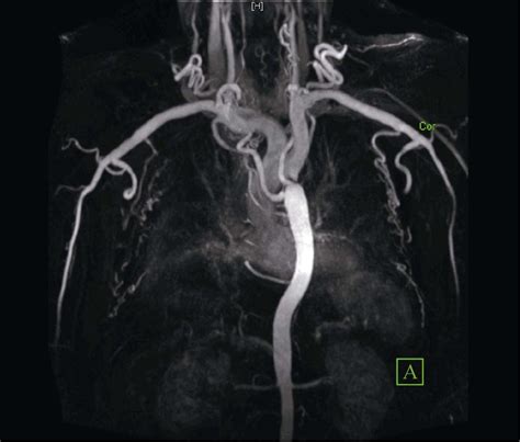 Magnetic Resonance Imaging Aortic Coarctation With Total Occlusion Of