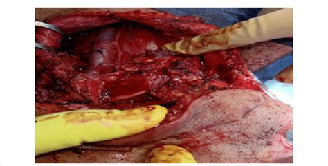 Neck Dissection In A Case Of Lower Lip Squamous Cell Carcinoma