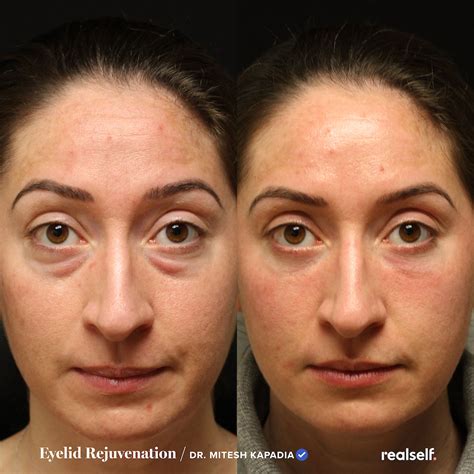 8 Things To Know Before And After Eyelid Surgery Realself News Eyelid