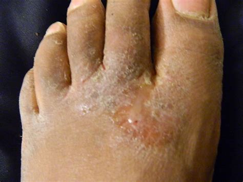 Athletes Foot Pariser Dermatology