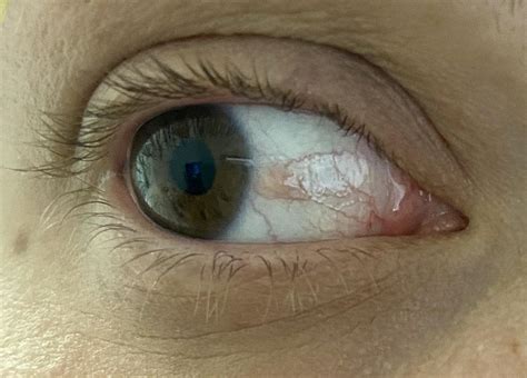 Film On My Eyeball Has A Clump Does Anyone Know What This Is R
