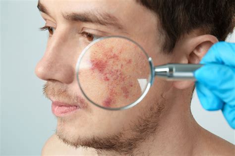 Skin Cancer On Face Images