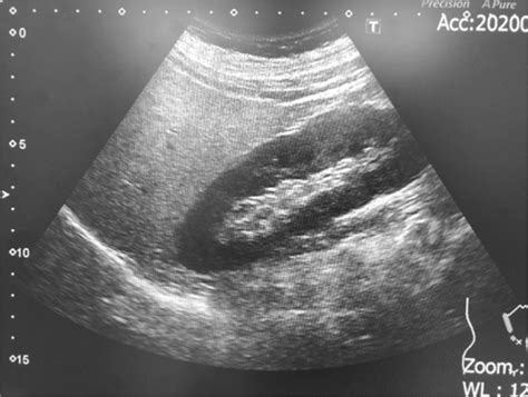 Ultrasonography Abdominal Ultrasonography Revealing A Bright Liver