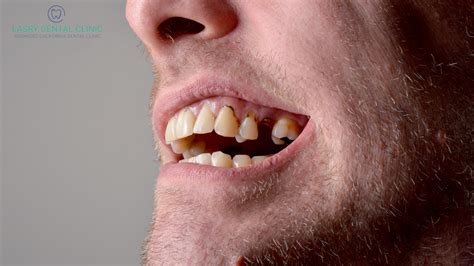 Do You Have Rotten Teeth Symptoms Pain And Treatment