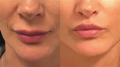 lip lift procedure with before and afters youtube