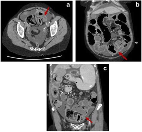 Ct Abdomen Showing Closed Loop Small Bowel Obstruction With Multiple