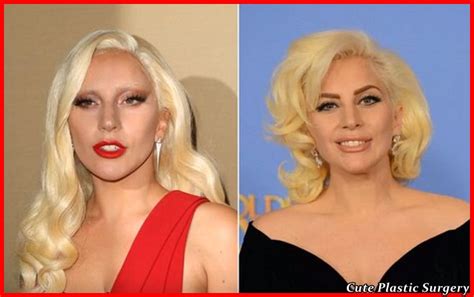 Lady Gaga Plastic Surgery Before And After Celebrities Plastic Surgery