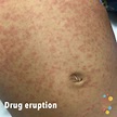 Drug eruption - Skin Deep
