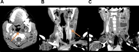 Large Liquefaction Of Lymph Nodes During Tuberculosis Associated Immune
