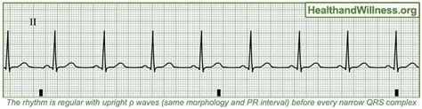 How To Read An Ekg Rhythm Strip Health And Willness