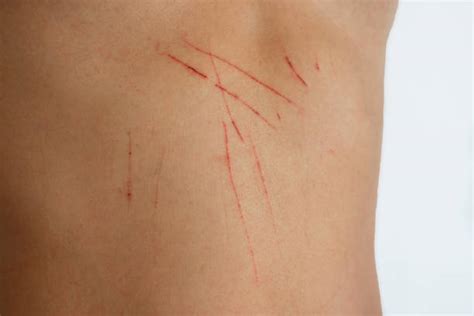 Scratch Mark Skin Stock Photos Pictures And Royalty Free Images Istock