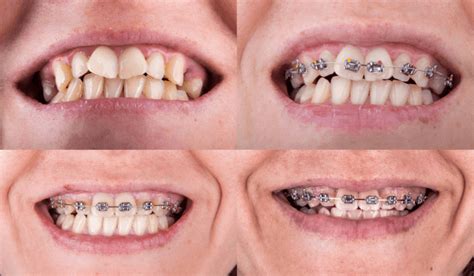 Dental Braces Types Of Braces Cost And Procedure How They Work