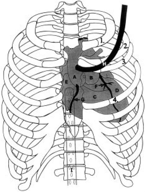 Schematic Drawing Of The Operative Situs The Third And The Fourth Rib