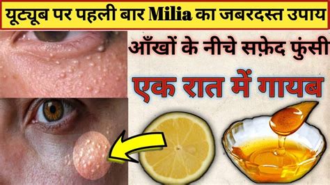 7 Days Challenge 😍 Get Rid Of Tiny Bumps Naturally At Home Milia Home