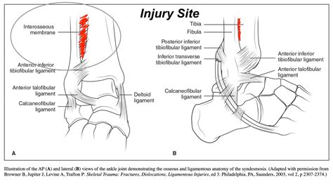 High Vs Low Ankle Sprains What S The Difference