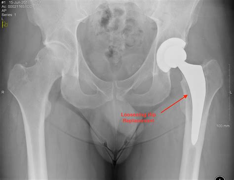 revision hip surgery knee and hip website