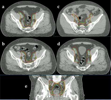 Consensus Guidelines And Contouring Atlas For Pelvic Node Delineation