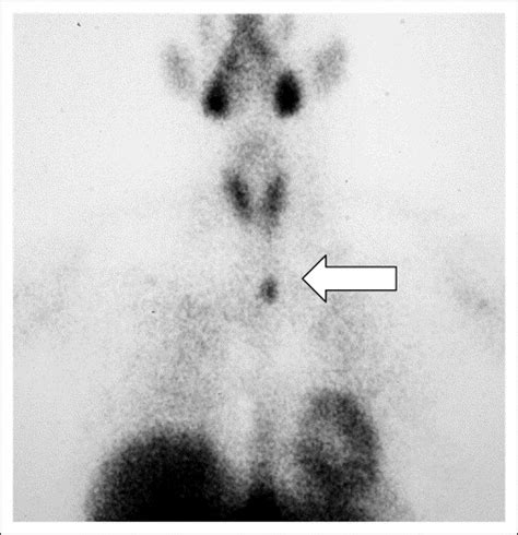 Incidence And Location Of Ectopic Abnormal Parathyroid Glands The
