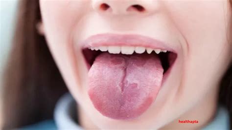 How To Heal A Burnt Tongue Youtube