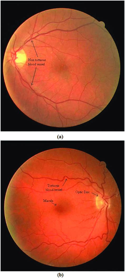 Retinal Fundus Images With A Normal Blood Vessels B Tortuous