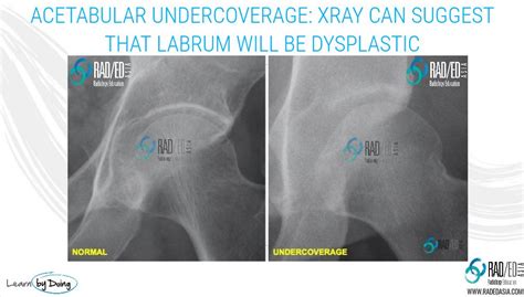 Hip Dysplastic Labrum Mri Acetabular Labrum More Than Just Tears Part